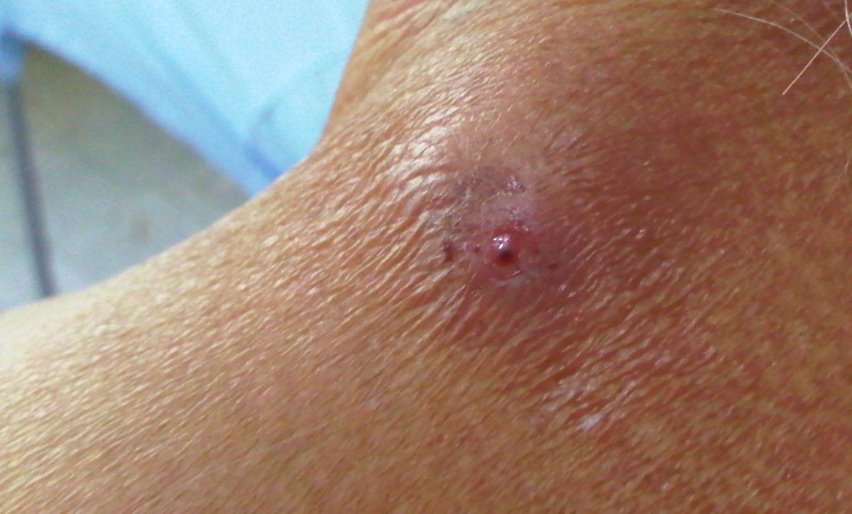 Herida en el cuello por gusano barrenador